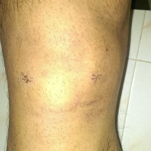 11 day after Meniscus Tear Stitches removal