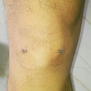 Post-Op Meniscus Tear 10 days after